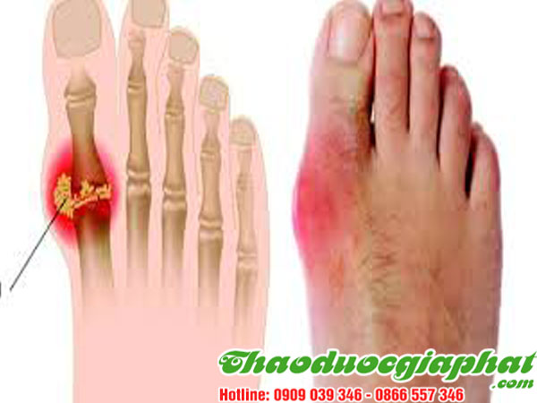 GOUT