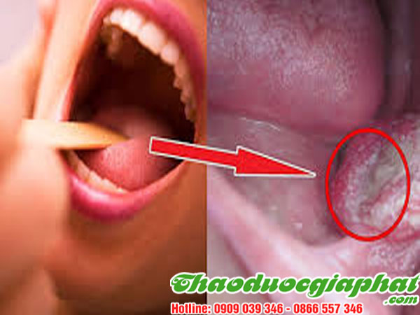 VIÊM HỌNG MÃN TÍNH