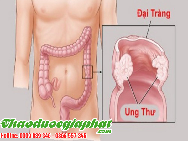 ba-kich-tim-dieu-tri-ung-thu-dai-trang-tai-quan-5