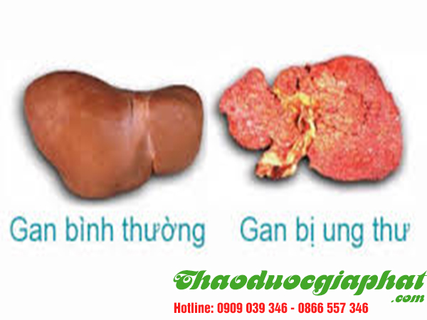 ba-kich-tim-dieu-tri-ung-thu-gan-tai-quan-11