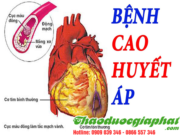 ba-kich-tim-giup-tri-cao-huyet-ap-tai-quan-thu-duc