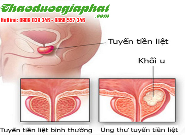 ban-chi-lien-tri-ung-thu-tuyen-tien-liet-tai-huyen-can-gio