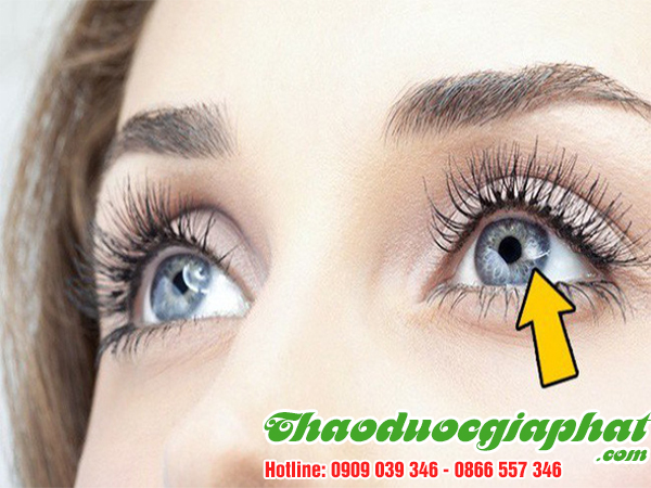 cau-ki-tu-giup-tri-chay-nuoc-mat-tai-quan-thu-duc