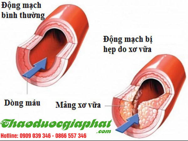 cay-bi-ki-nam-giup-ngan-ngua-xo-vua-dong-mach-tai-huyen-can-gio