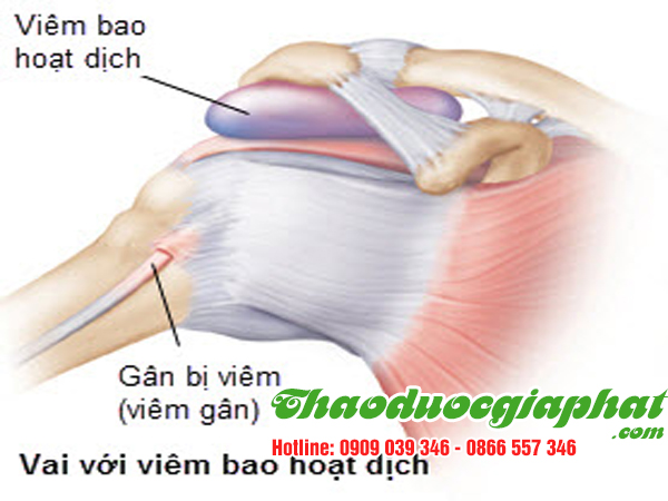 cay-chia-voi-huyen-can-gio-tri-viem-bao-hoat-dich-khop