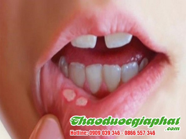 cay-chia-voi-quan-9-tri-loet-mieng