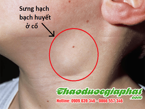 cay-chia-voi-quan-tan-phu-tri-sung-hach-bach-huyet
