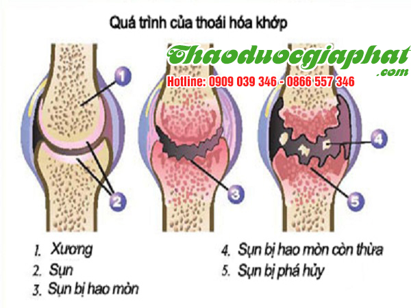 cay-coi-xay-tri-thoai-hoa-khop-tai-huyen-nha-be