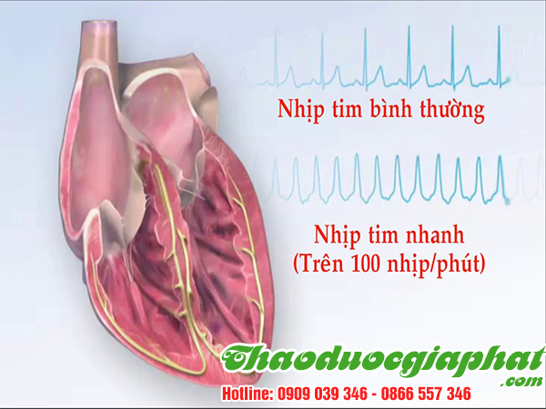 cay-hoang-ky-tri-tim-dap-nhanh-tai-quan-go-vap