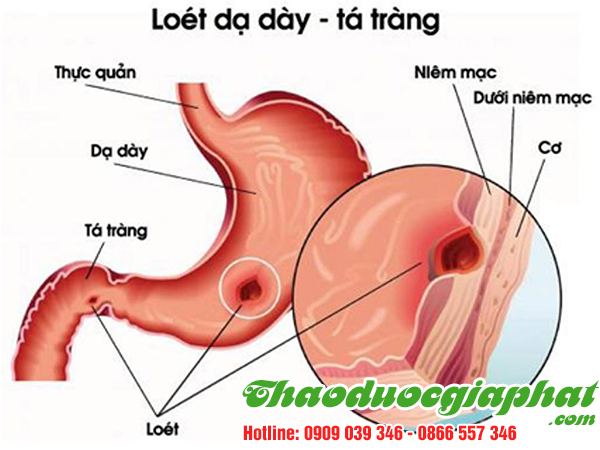 cay-hoang-ky-tri-viem-loet-da-day-tai-quan-thu-duc