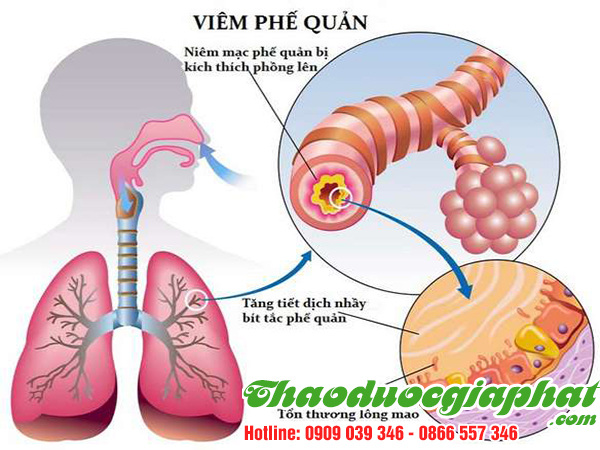 cay-hoang-ky-tri-viem-phe-quan-tai-quan-12