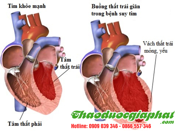 cay-tom-trong-dieu-tri-suy-tim-tai-quan-6.