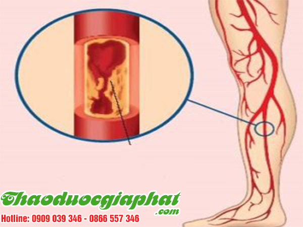 cay-tom-trong-giup-giam-acid-uric-trong-mau-tai-quan-phu-nhuan