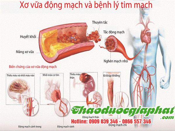 cay-tom-trong-giup-ngan-ngua-xo-vua-dong-mach-tai-quan-11