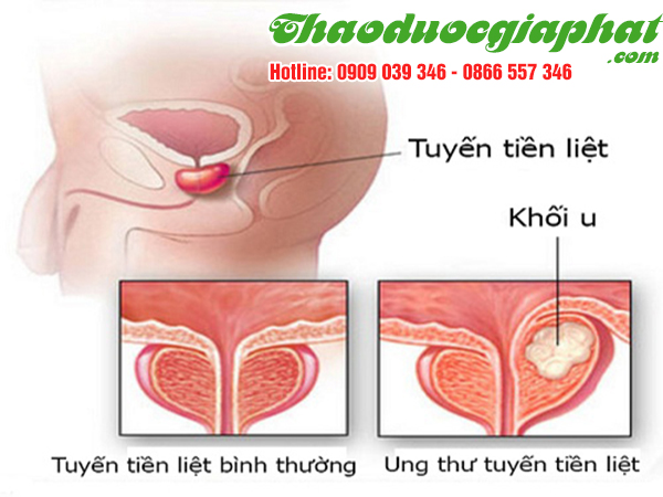 cay-tom-trong-giup-phong-chong-ung-thu-tuyen-tien-liet-tai-huyen-cu-chi