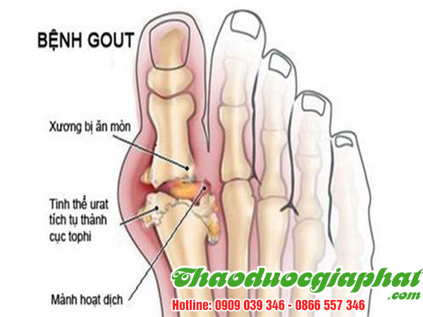 cay-tom-trong-tri-benh-gout-tai-quan-1