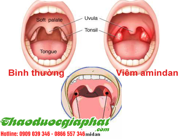 cay-voi-voi-tri-viem-amidan-tai-quan-6