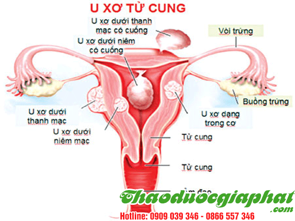 dieu-tri-u-xo-tu-cung-hieu-qua-tai-huyen-hoc-mon