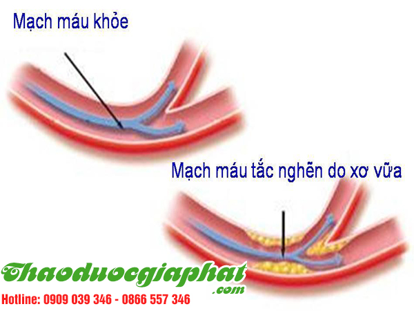 hoa-tam-that-giup-dieu-tri-xo-vua-dong-mach-tai-quan-binh-tan