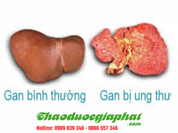 nam-lim-xanh-tri-ung-thu-gan-tai-quan-2