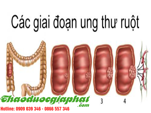 nam-lim-xanh-tri-ung-thu-ruot-tai-quan-7