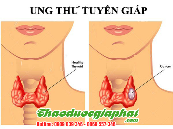 nam-lim-xanh-tri-ung-thu-tuyen-giap-tai-quan-11