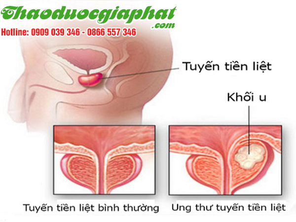 nam-lim-xanh-tri-ung-thu-tuyen-tien-liet-tai-quan-tan-binh