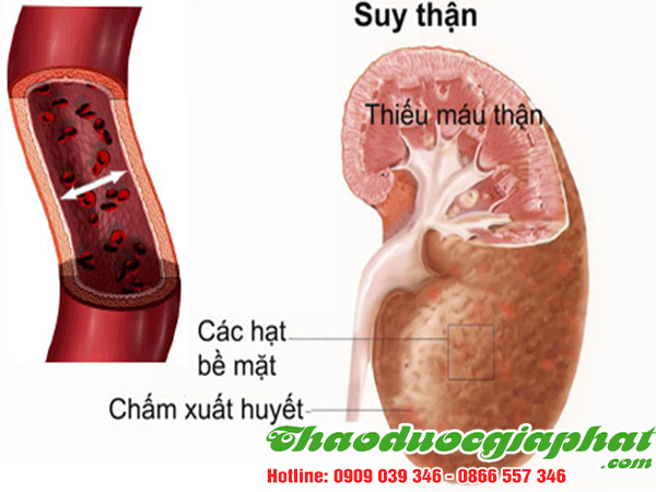 sam-duong-quy-tr-suy-than-tai-quan-5.