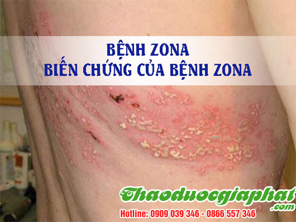 tao-meo-tri-benh-zona-tai-quan-10