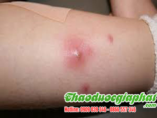 mua bán cây sài đất giúp trị mụn nhọt tại quận 2 ???