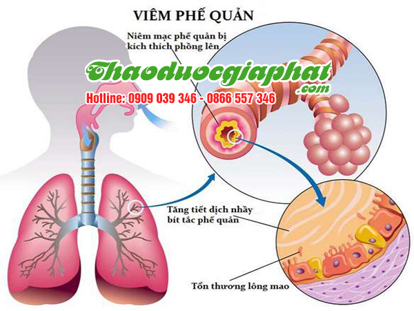 xuyen-tam-lien-giup-tri-viem-phe-quan-tai-quan-5