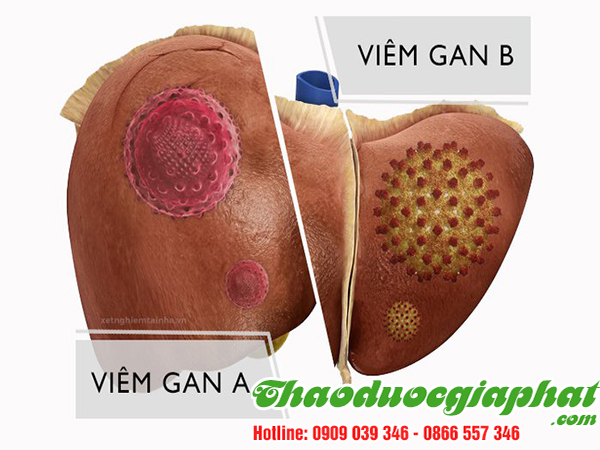 xuyen-tam-lien-tai-viem-gan-b-tai-quan-phu-nhuan