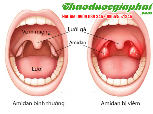 xuyen-tam-lien-tri-viem-amidan-tai-quan-binh-thanh