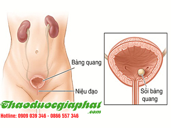 xuyen-tam-lien-tri-viem-bang-quang-tai-quan-11