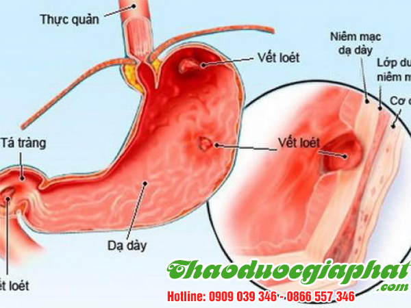 xuyen-tam-lien-tri-viem-da-day-cap-tai-quan-8