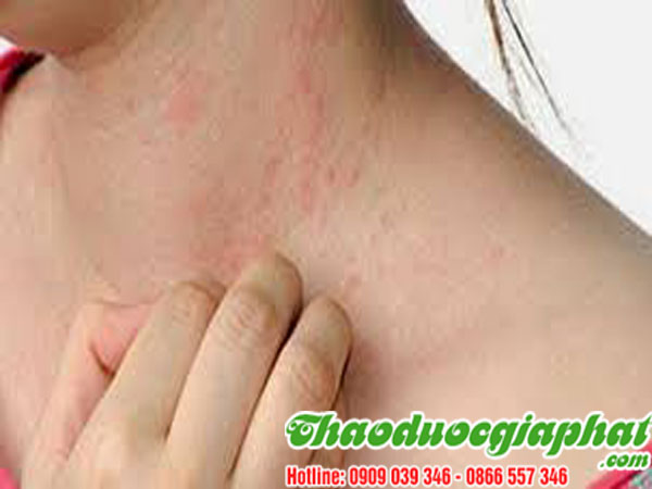 mua-ban-cay-du-de-tai-quan-1-hieu-qua-tri-man-ngua