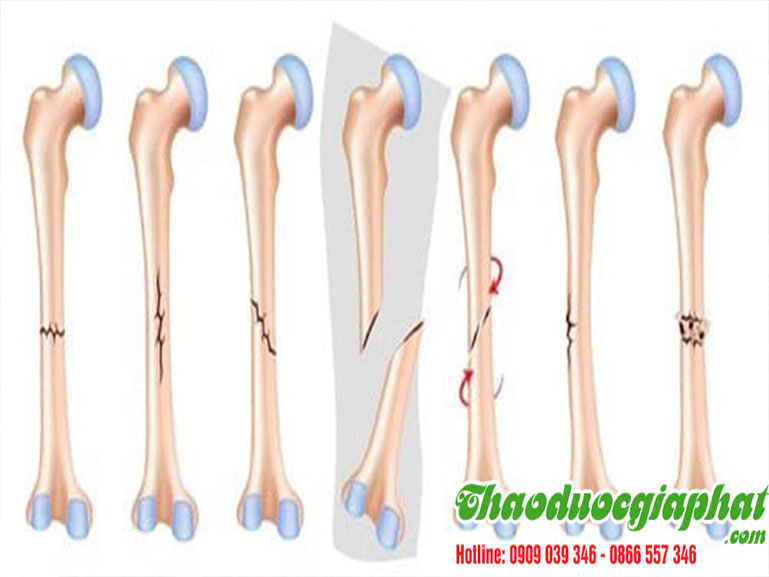 cay-bim-bip-tai-quan-12-uy-tin-dieu-tri-gay-xuong