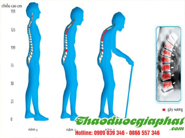 cay-bim-bip-tai-quan-thu-duc-uy-tin-thoat-hoa-cot-song