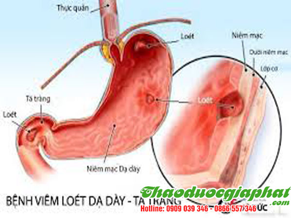 cay-co-muc-dieu-tri-chay-mau-da-day-tai-quan-2-tot-nhat