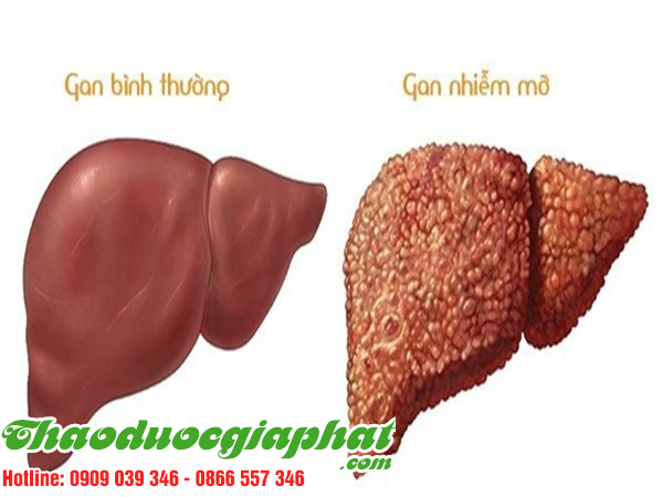 cay-co-muc-tri-gan-nhiem-mo-tai-quan-11-tot-nhat