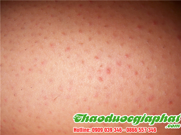 cay-co-muc-tri-viem-da-di-ung-hieu-qua-tai-quan-go-vap
