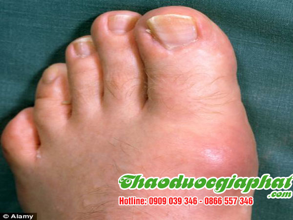 cay-no-ngay-dat-tri-benh-gout-tai-quan-2