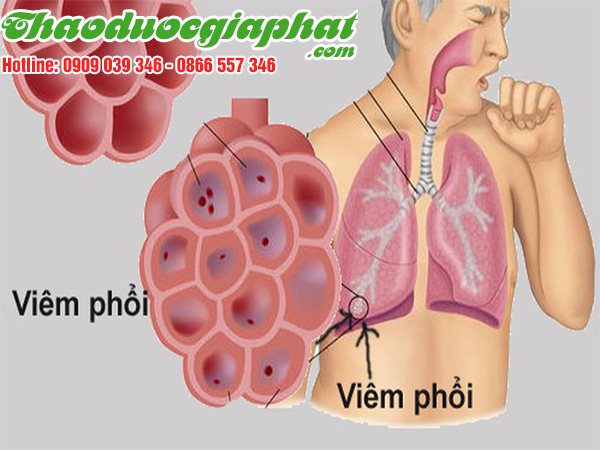 cay-sai-dat-chat-luong-nhat-tai-huyen-cu-chi-tri-viem-phoi