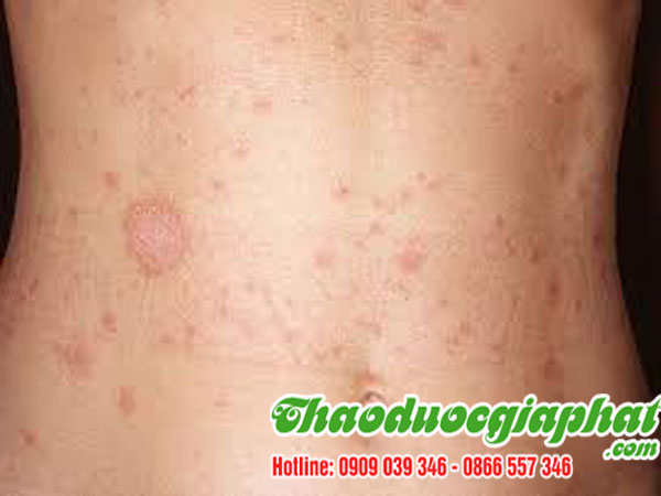 cay-sai-dat-chat-luong-nhat-tai-quan-7-tri-man-ngua-ngoai-da