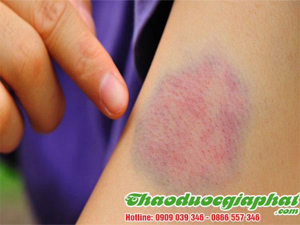 cay-thuoc-doi-tri-cac-vet-tham-tim-da-tai-quan-tan-phu