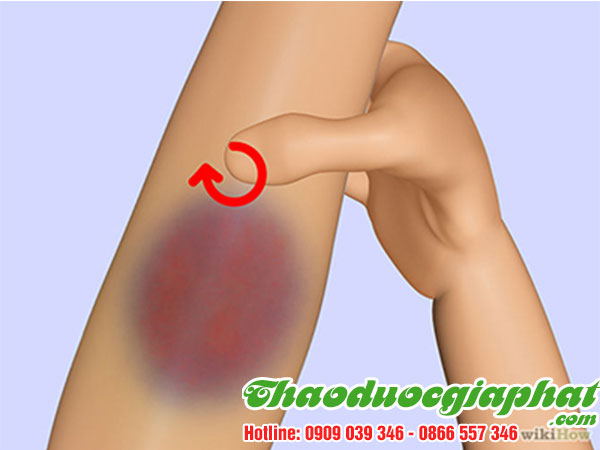 cay-thuoc-doi-tri-vet-bam-tim-tren-da-tai-huyen-binh-chanh