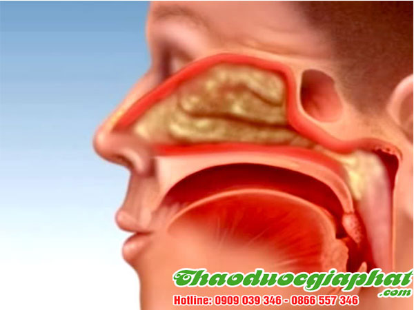 cay-thuoc-doi-tri-viem-sung-mui-tai-quan-2