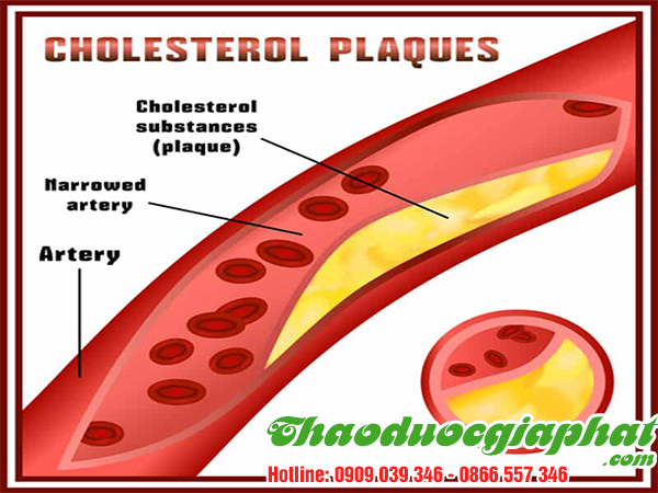 day-thia-canh-dieu-tri-cholesterol-trong-mau-tai-quan-5.