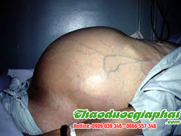diep-ha-chau-dieu-tri-xo-gan-co-truong-tai-quan-2.