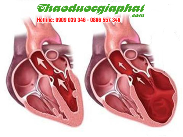 dieu-tri-thap-tim-hieu-qua-tai-huyen-can-gio